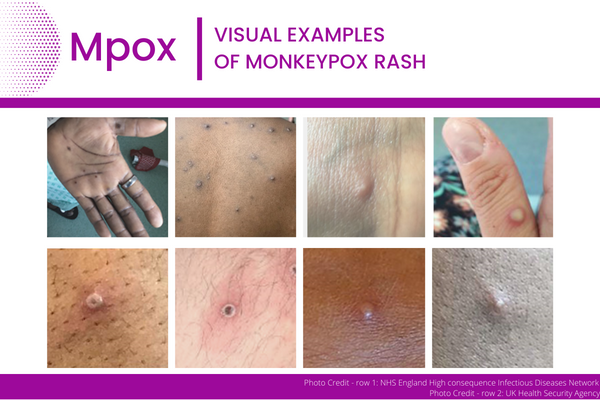 Mpox