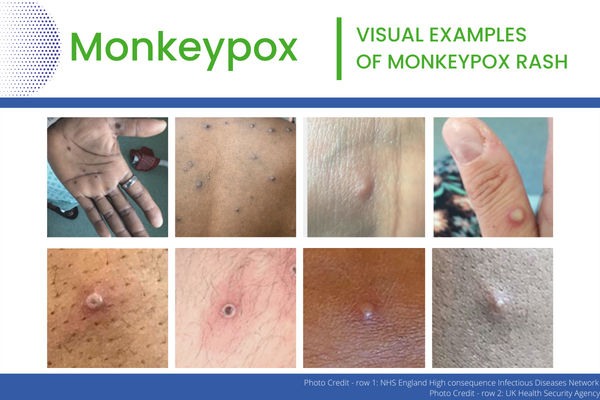 Monkeypox - Visual Examples of Rash